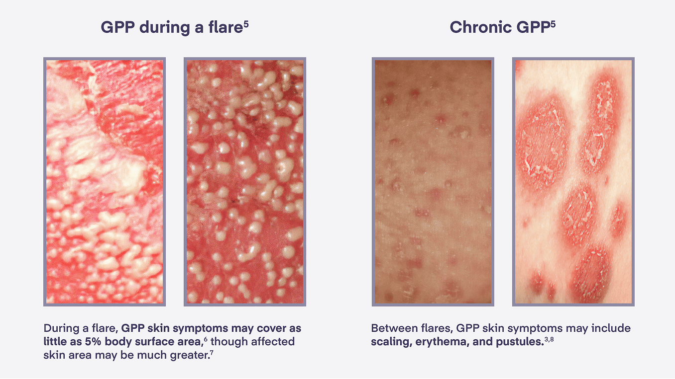 What GPP Flares And Chronic GPP Look Like On Skin
