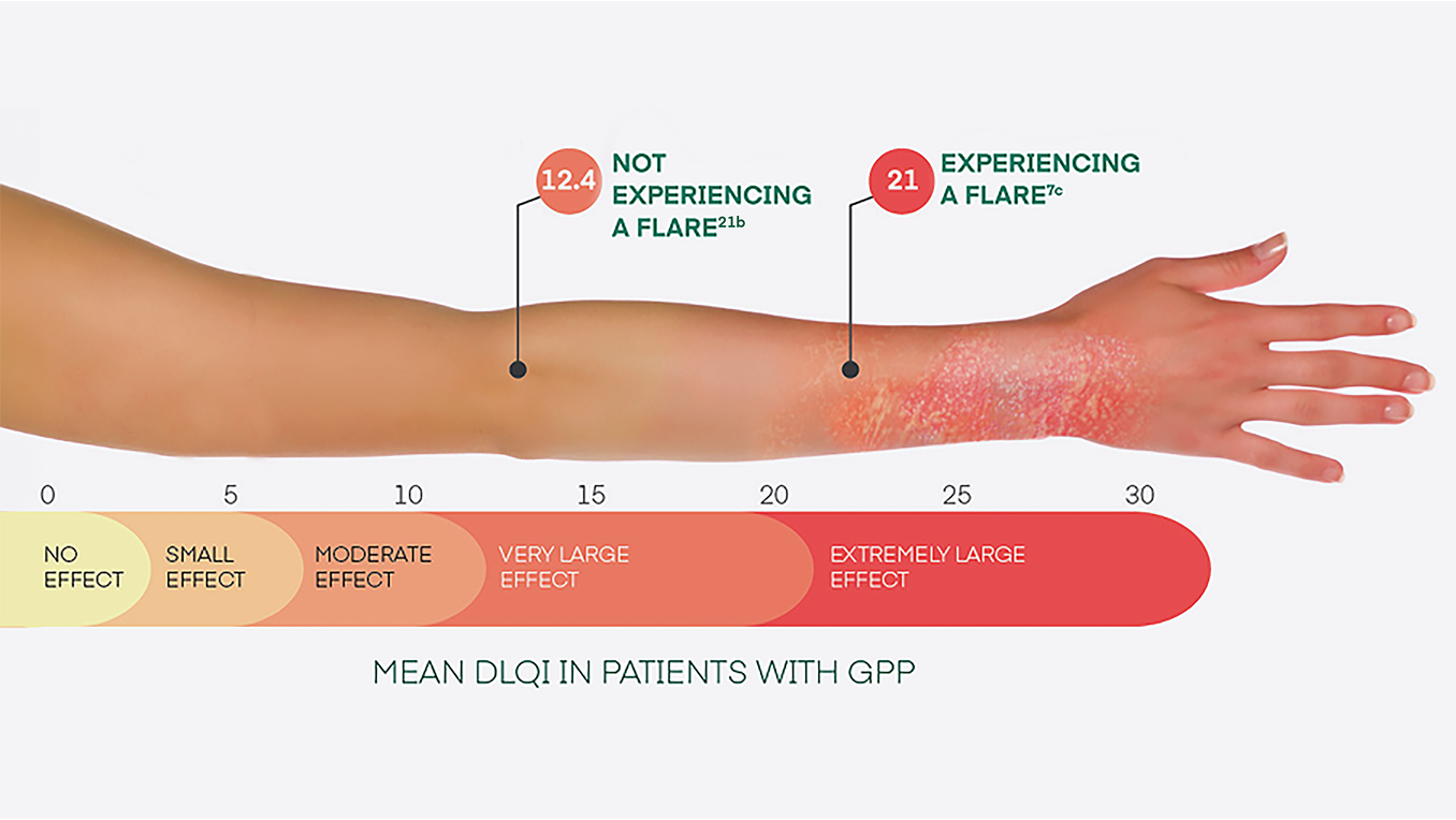 Mean DLQI In Patients With GPP