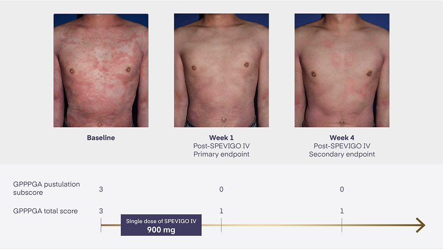 Patient With GPP Flare Who Participated In Effisayil 1 Trial